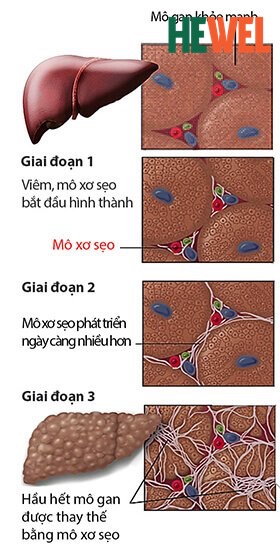 viem gan qua giai doan