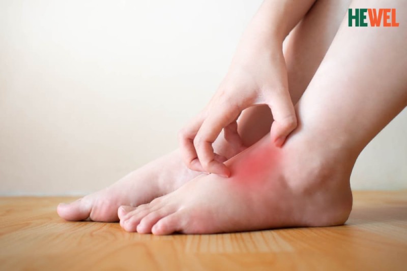 ngứa dấu hiệu bệnh gan