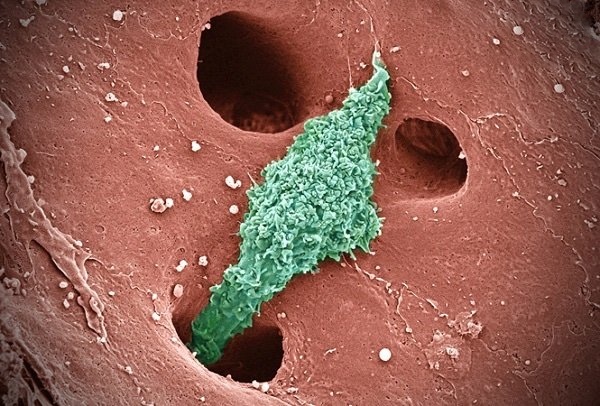 tế bào kupffer kích hoạt quá mức