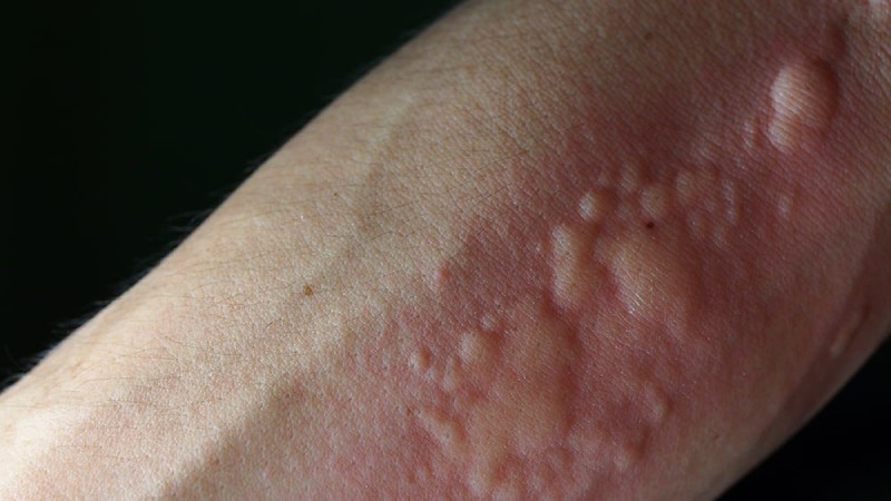 thường bị nổi mề đay