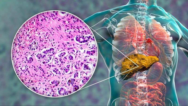 nhiễm mỡ ở gan