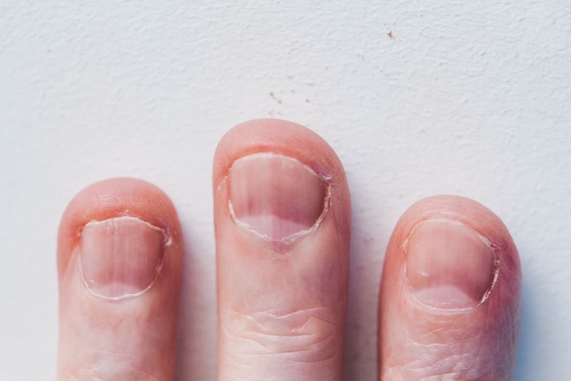 móng tay lồi lõm
