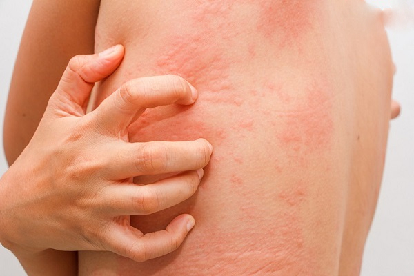 dấu hiệu dị ứng da