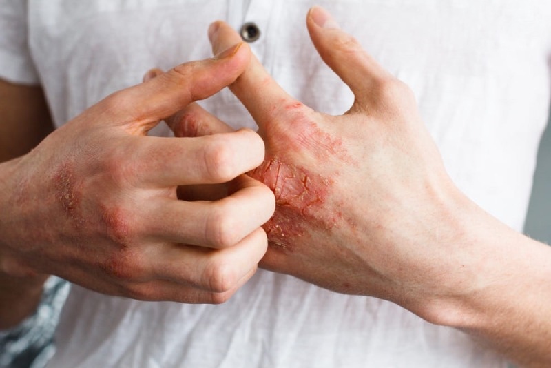 bệnh eczema gây ngứa da