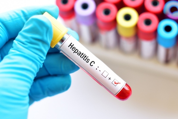 các xét nghiệm chẩn đoán viêm gan c