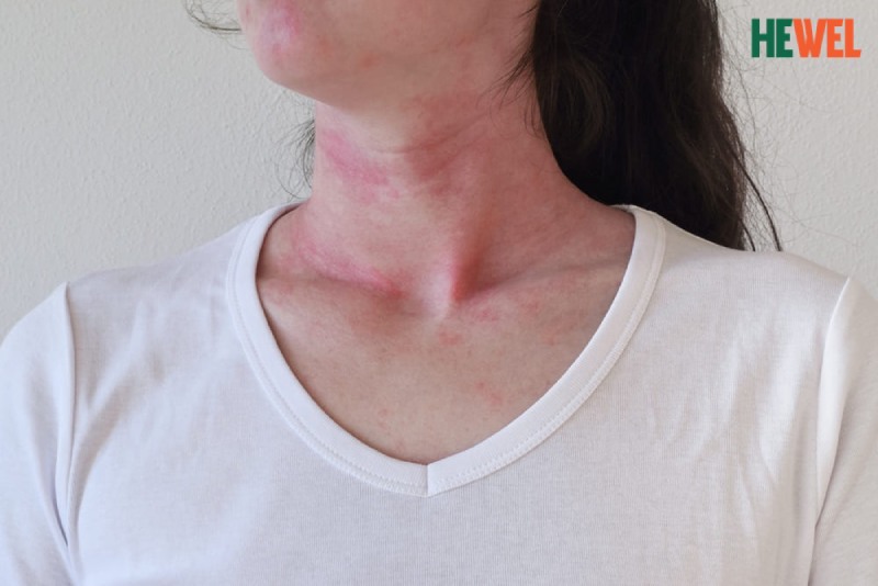 Các bệnh ngứa da thường gặp: Ngứa toàn thân, ngứa đầu, ngứa da mặt
