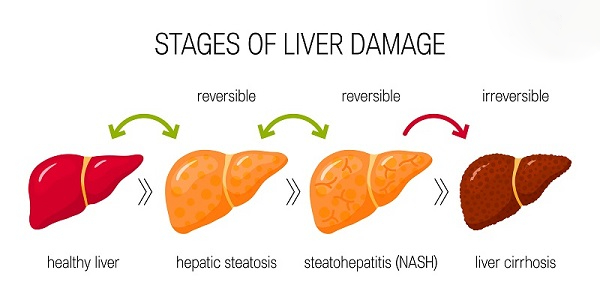 tiến triển gan nhiễm mỡ