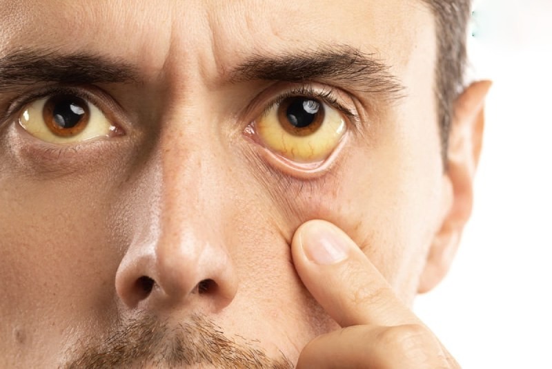 biểu hiện viêm gan