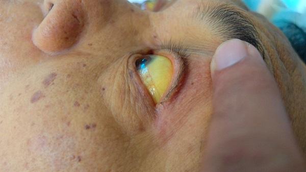 màu mắt chuyển màu