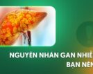 7 nguyên nhân gan nhiễm mỡ và phương pháp chẩn đoán bệnh?