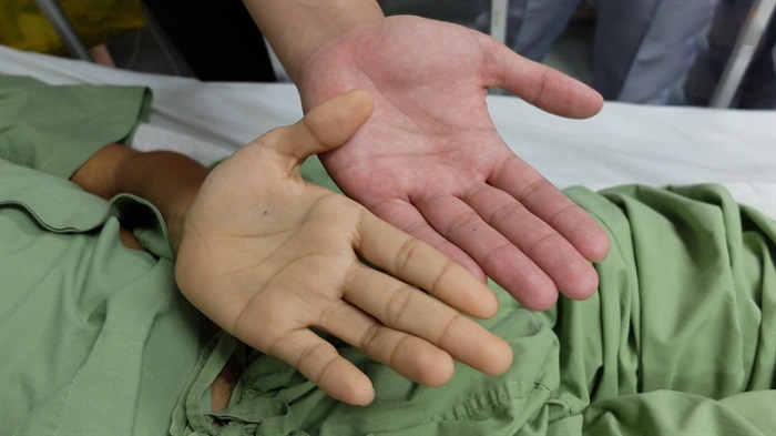 vàng da là bệnh gì