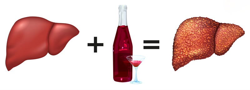 viêm gan do rượu