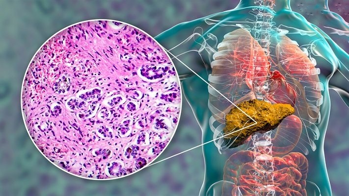 xơ gan do bia rượu