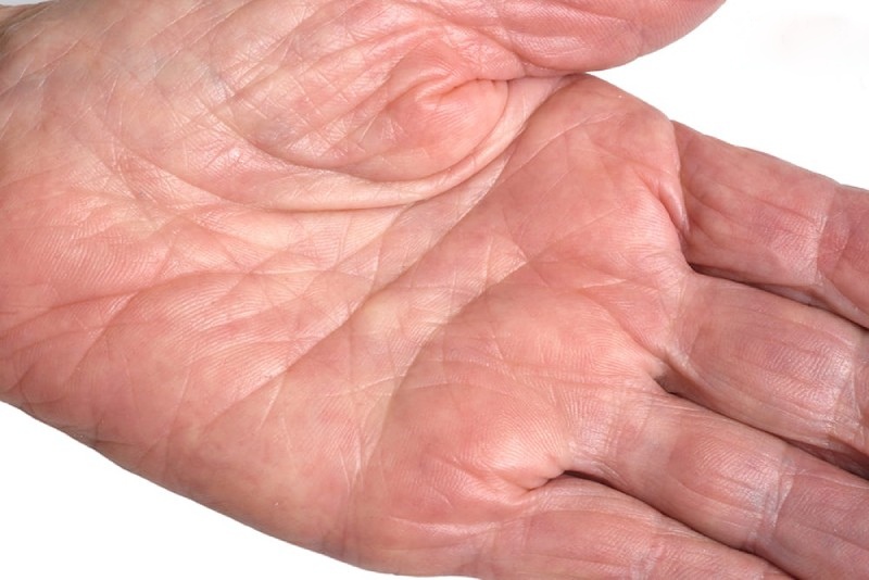 lòng bàn tay đỏ