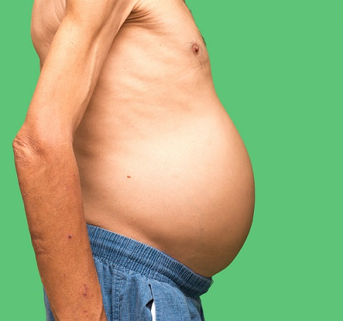 xơ gan mất bù giai đoạn nặng