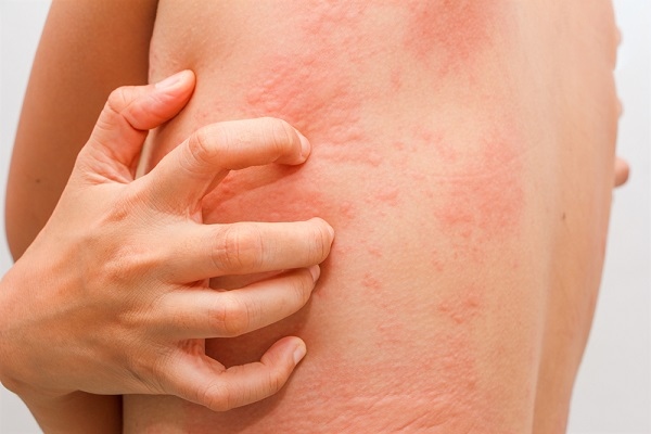bị nổi mề đay