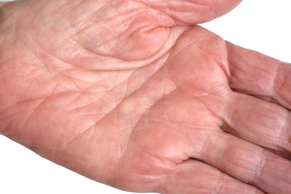 biến chứng viêm gan virus b