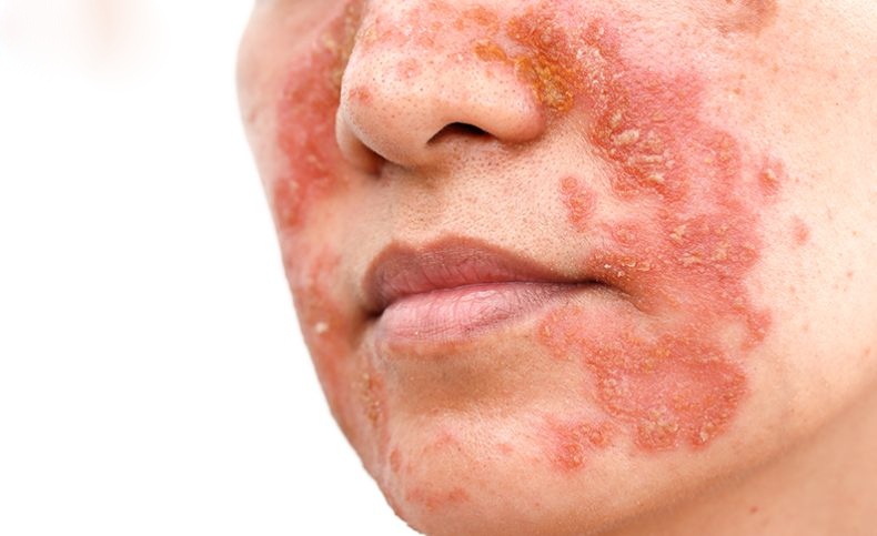 dấu hiệu bệnh viêm da