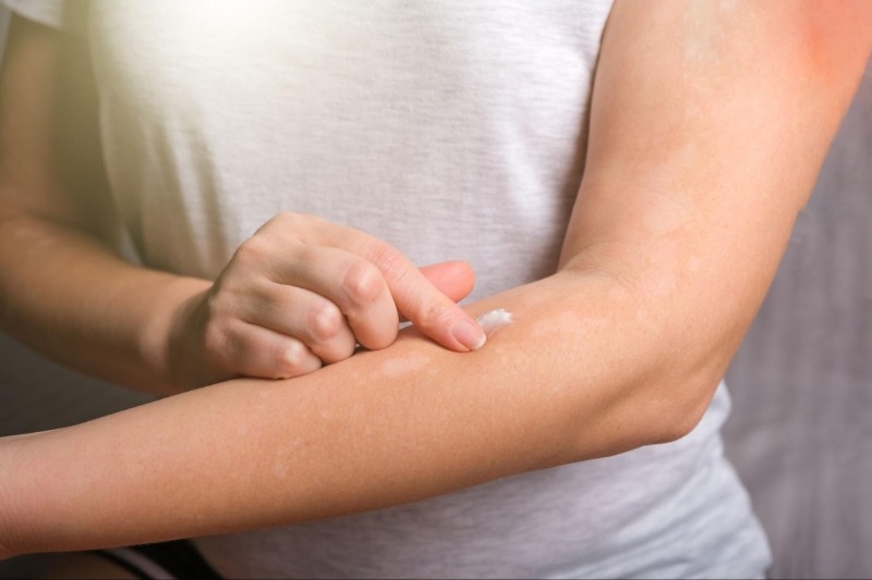 Viêm da cơ địa: Nguyên nhân, triệu chứng và cách phòng ngừa