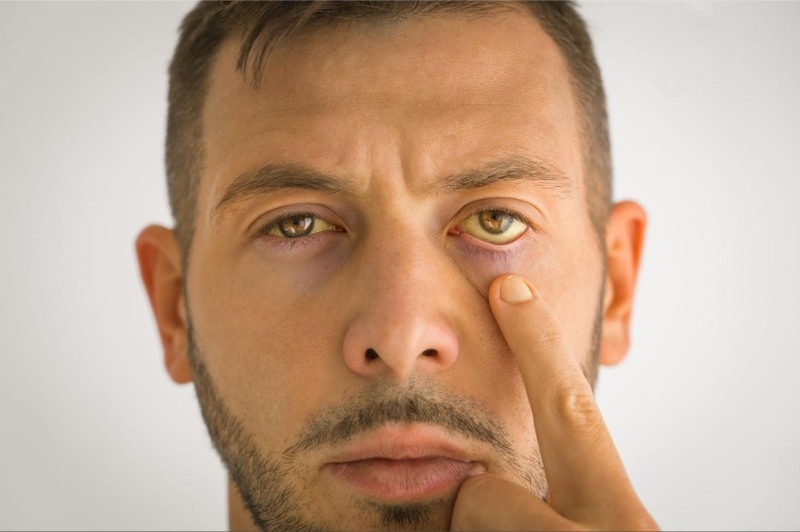 vàng tròng trắng mắt