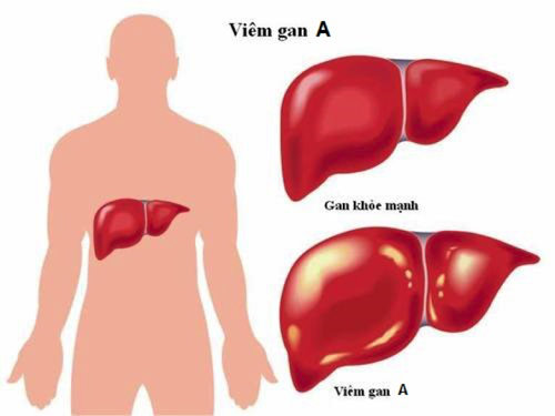 Tìm hiểu về bệnh viêm gan A và cách hỗ trợ phòng ngừa