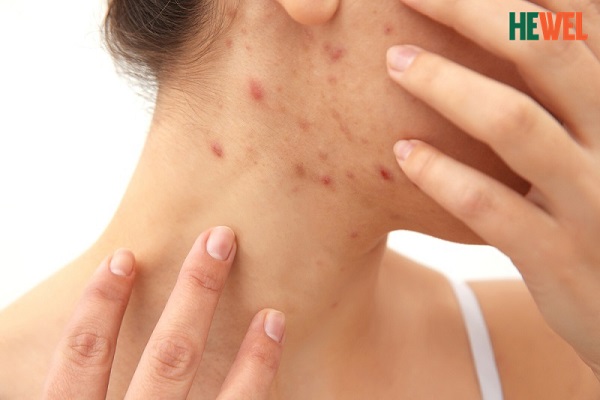 Dị ứng da – nguyên nhân triệu chứng và cách điều tri