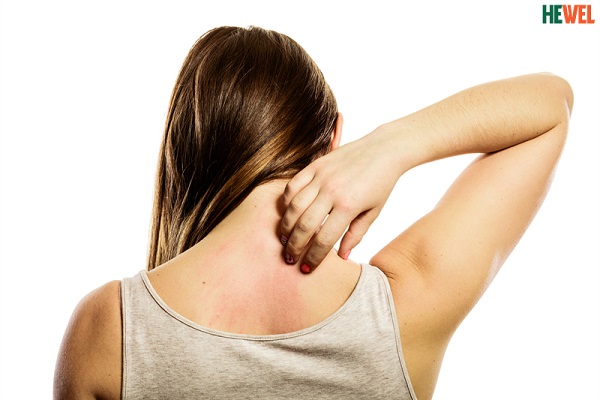 Da khô ngứa, sạm mụn nhọt cảnh báo dấu hiệu của bệnh gan