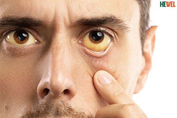 9 Bệnh về gan và cách phòng ngừa hiệu quả