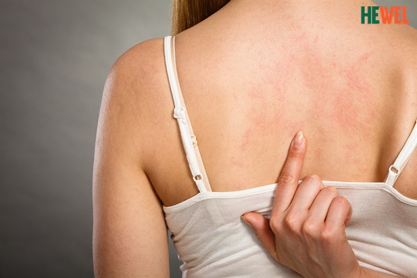 Nổi mẩn ngứa mẩn đỏ khắp người có phải bệnh gan?