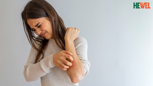 Bệnh nổi mề đay – nguyên nhân triệu chứng và cách điều trị