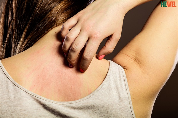 Nổi mụn, sạm da, vàng da có phải nóng gan không?
