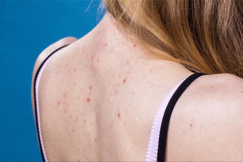 nóng trong người mọc mụn