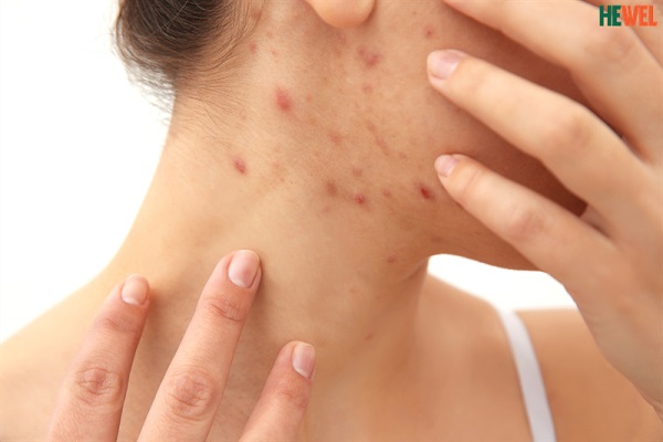 Dấu hiệu nóng gan nổi mụn và cách điều trị