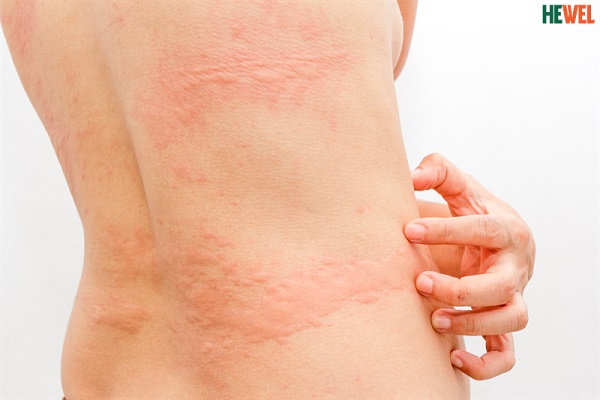 Nóng trong người nổi mề đay và cách điều trị