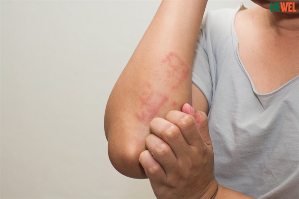 Bệnh sẩn ngứa do gan phải làm sao?