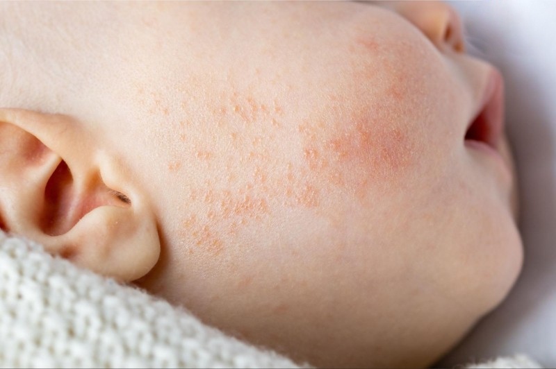 trẻ bị viêm da dị ứng