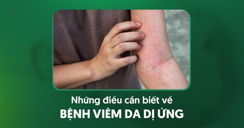 6 triệu chứng viêm da dị ứng: Nguyên nhân và cách phòng ngừa