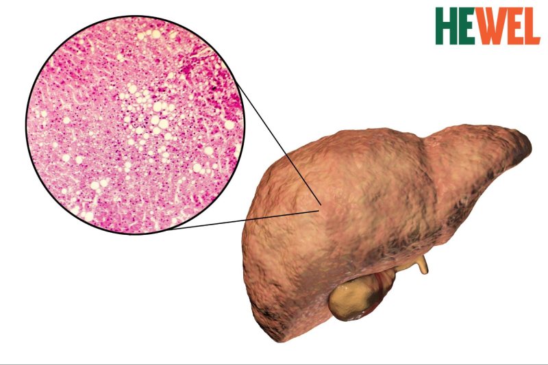 bệnh gan nhiễm mỡ