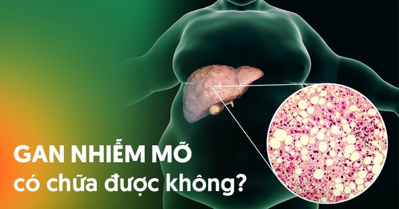 Bị gan nhiễm mỡ có chữa được không, có khỏi bệnh dứt điểm không?