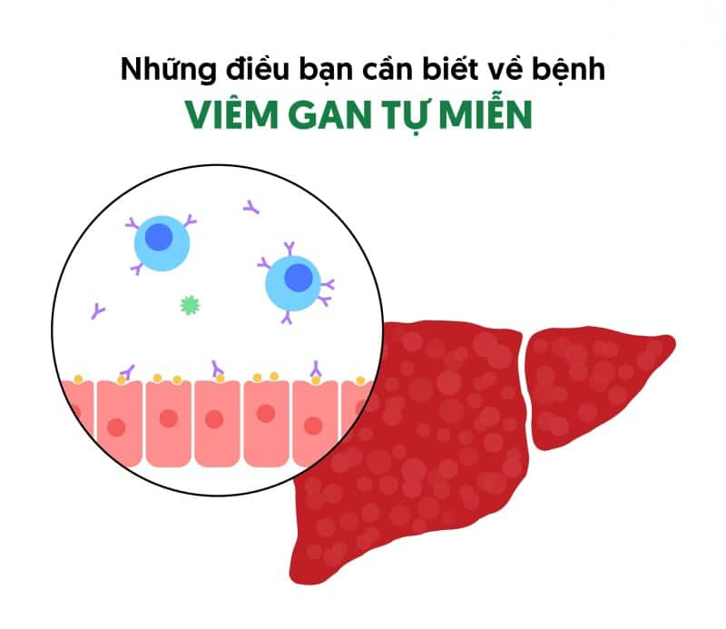 viêm gan tự miễn