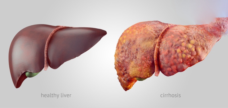 các biến chứng gan nhiễm mỡ