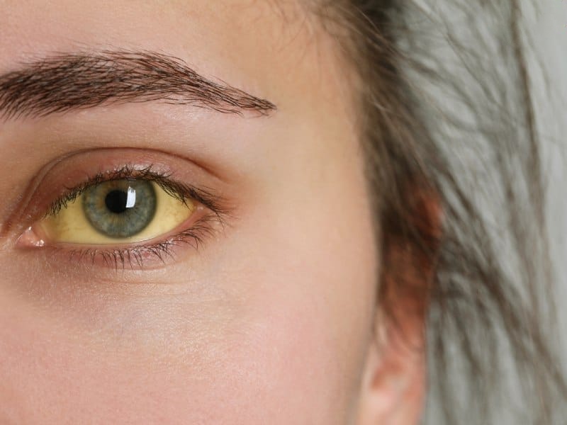 vàng da vàng mắt