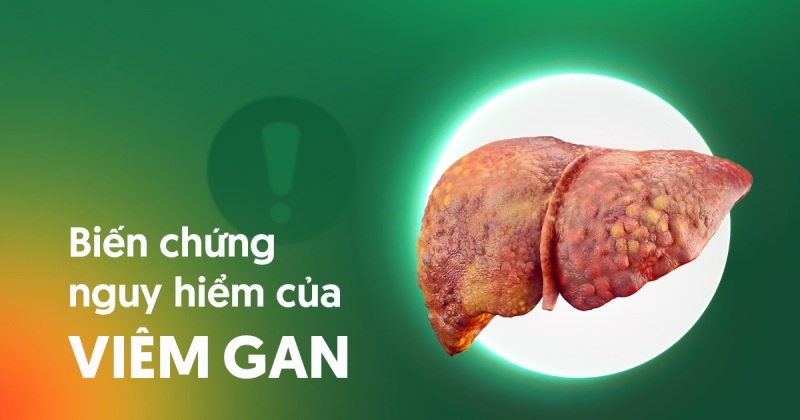 10 biến chứng viêm gan phổ biến – Bệnh có nguy hiểm không?