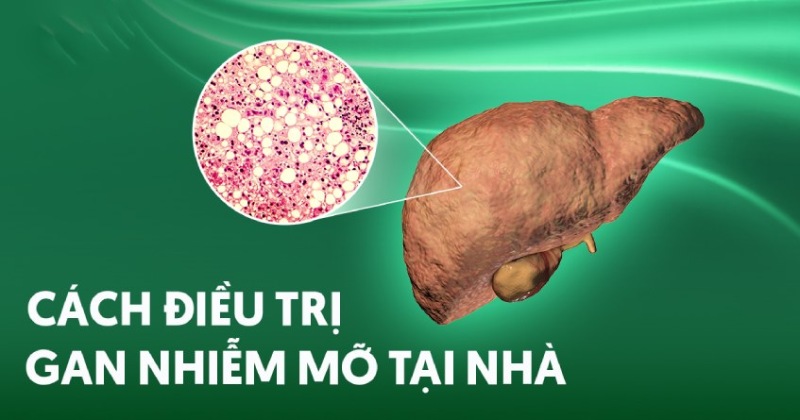 12 cách trị gan nhiễm mỡ tại nhà tăng cường sức khỏe cho gan