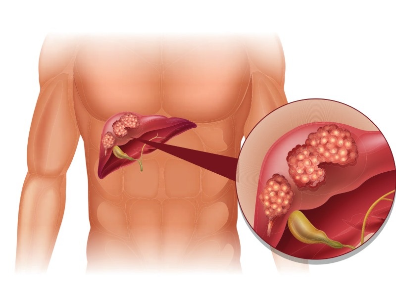 viêm gan biến chứng ung thư gan