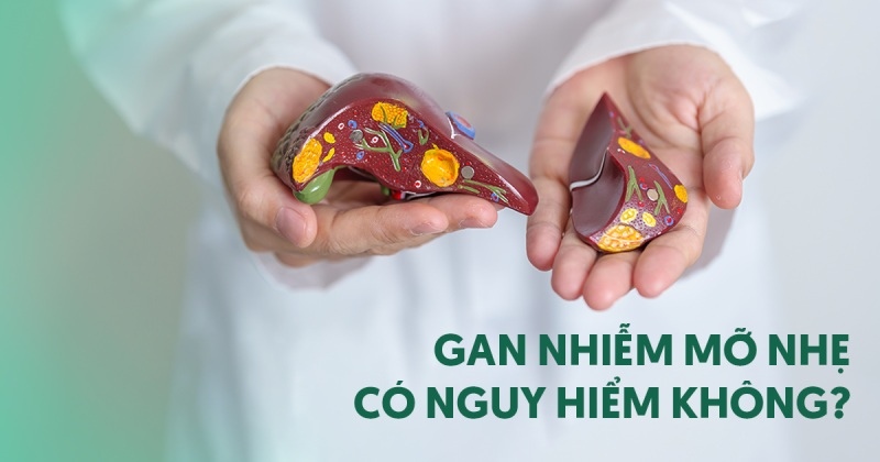 Gan nhiễm mỡ nhẹ: Nguyên nhân, điều trị và phòng ngừa