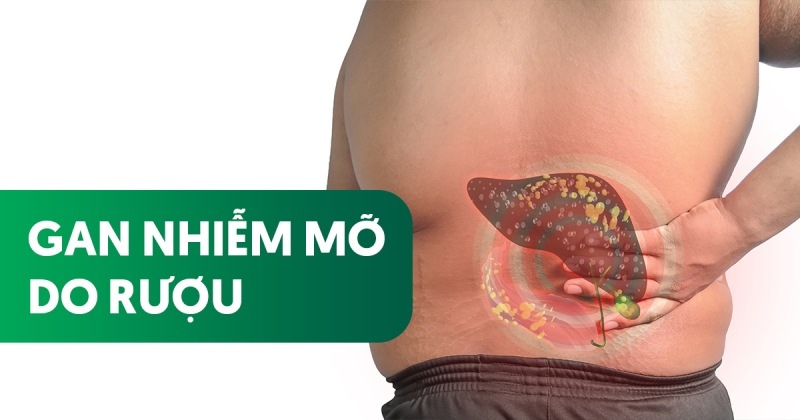 gan nhiễm mỡ do rượu