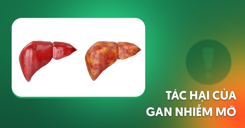 5 tác hại của gan nhiễm mỡ gây ảnh hưởng tiêu cực cho sức khỏe