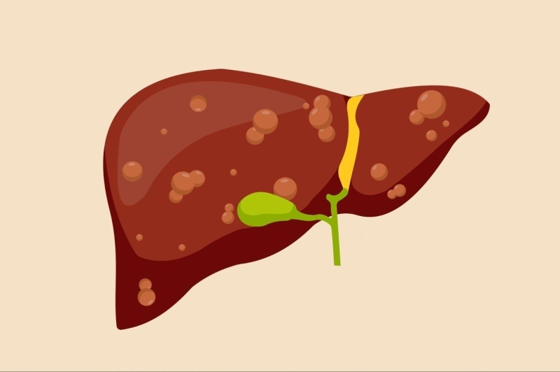 gan nhiễm mỡ biến chứng