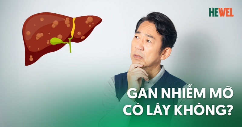 Bệnh gan nhiễm mỡ có lây không? [Chuyên gia giải đáp]